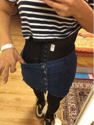 腰腹吸脂整形對(duì)比圖 肚子小了很多