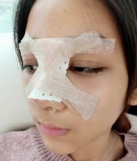 隆鼻整形日記，像變了個人似的