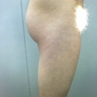 大腿抽脂瘦大腿恢復(fù)全過程我也有纖細的美腿了