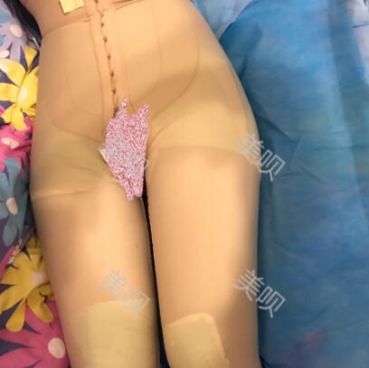 大腿抽脂瘦大腿恢復(fù)全過程我也有纖細的美腿了