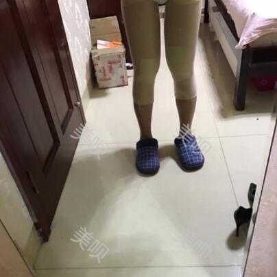 大腿抽脂瘦大腿恢復(fù)全過程我也有纖細的美腿了