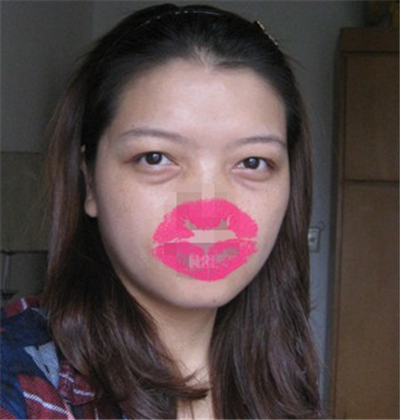 外切去眼袋手術(shù)過程和恢復(fù)前后對比照片分享，劉志飛醫(yī)生做的~