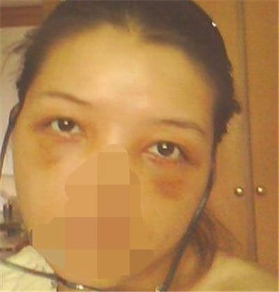 外切去眼袋手術(shù)過程和恢復(fù)前后對比照片分享，劉志飛醫(yī)生做的~