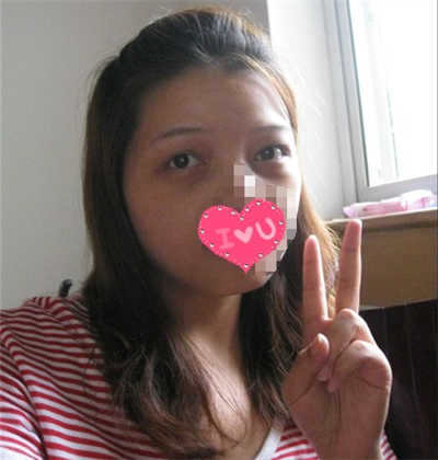 外切去眼袋手術(shù)過程和恢復(fù)前后對比照片分享，劉志飛醫(yī)生做的~