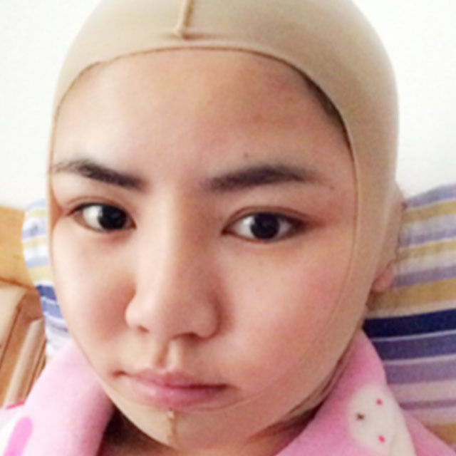 磨下頜角磨顴骨手術(shù)恢復(fù)過程和前后對比果照片分享哦~