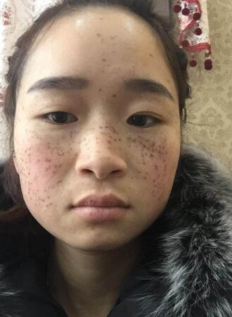 激光祛斑第二天開始結疤后的圖片