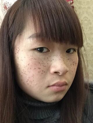 激光祛斑第三天早上