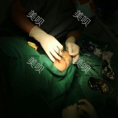 硅膠假體隆鼻+耳軟骨墊鼻尖大家看看果還不錯吧