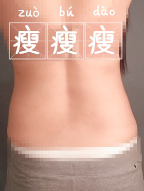 腰腹吸脂手術(shù)后，我也擁有“小蠻腰”啦!