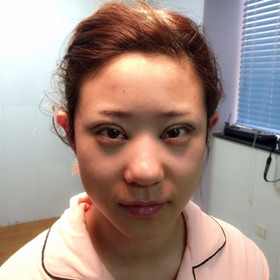 切開(kāi)雙眼皮+開(kāi)內(nèi)眼角手術(shù)前后過(guò)程，還有對(duì)比照片喲!