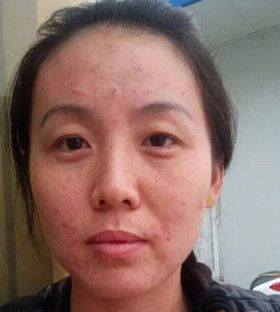激光祛痘后終于讓我擺脫了“痘友”行列!