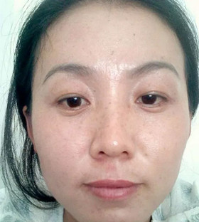 激光祛痘后終于讓我擺脫了“痘友”行列!