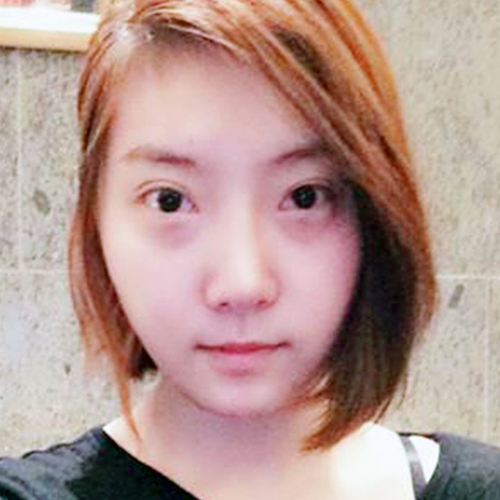 米蘭柏羽做了外切去眼袋，分享手術(shù)前后對比果圖片哦~