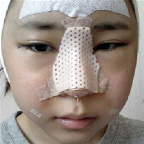 北京柏麗李勁良做的隆鼻整形，分享術(shù)后恢復(fù)果照片~