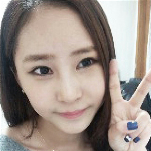 北京柏麗李勁良做的隆鼻整形，分享術(shù)后恢復(fù)果照片~