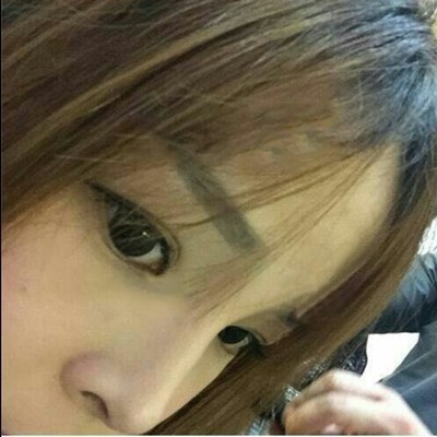 玻尿酸注射隆鼻三個月了，分享術后恢復照片哇~