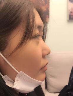 我鼻部綜合整形前的圖片
