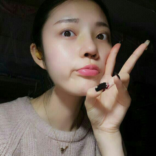 做了隆鼻整形手術(shù)好看多了，分享前后對比果照片~