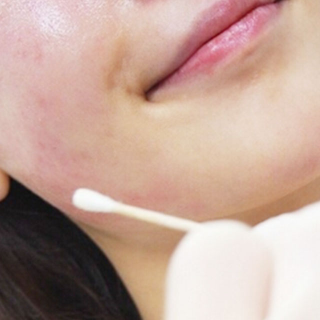 注射水光補(bǔ)水嫩膚果照片分享，杭州藝星柏亞萍醫(yī)生做的哦~