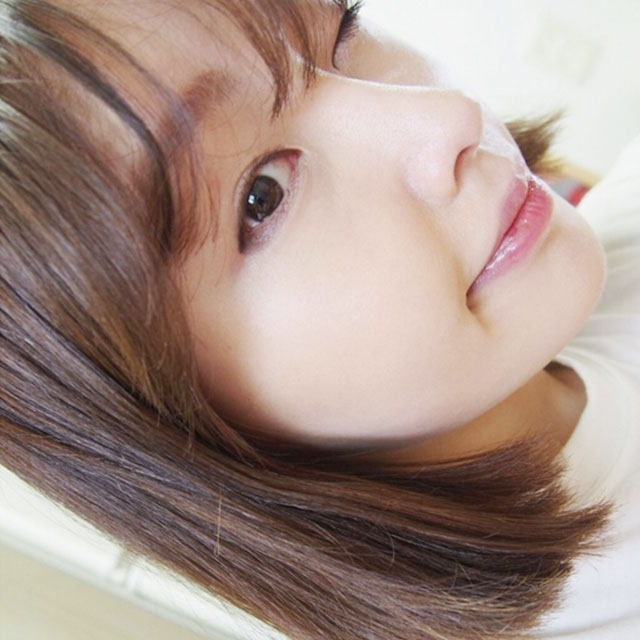 注射水光補(bǔ)水嫩膚果照片分享，杭州藝星柏亞萍醫(yī)生做的哦~