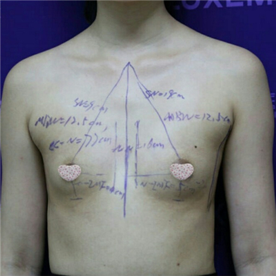 膨體假體隆胸手術(shù)過(guò)程分享，還有前后對(duì)比果照片哦~