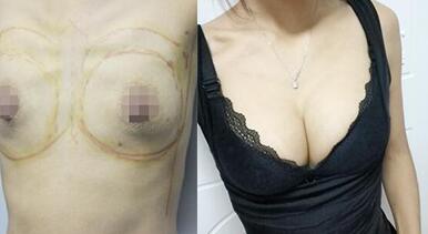 隆胸恢復(fù)過(guò)程和隆胸前后對(duì)比照片