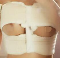 假體隆胸設(shè)計(jì)的手術(shù)方案是:腋下切口,進(jìn)口品牌毛面水滴假體,胸部由A豐到C