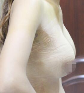 假體隆胸術(shù)后一周,拆完線