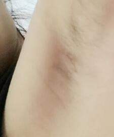 假體隆胸快術(shù)后兩個(gè)月了,腋下傷口已經(jīng)完全愈合