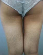 吸脂減肥瘦大腿術(shù)前