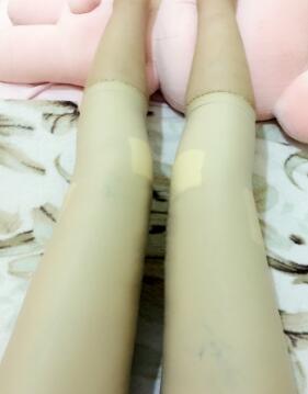 吸脂減肥瘦大腿第8天了，今天去拆線