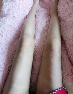 大腿吸脂手術(shù)后一直沒有洗腿，不敢洗，怕傷口感染