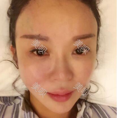 自體脂肪全臉填充讓我變得年輕漂亮了