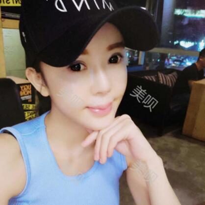 自體脂肪全臉填充讓我變得年輕漂亮了