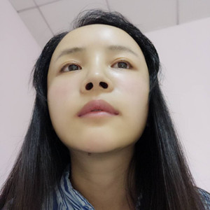 做了自體脂肪填充面部，臉部一下子就飽滿了不少!