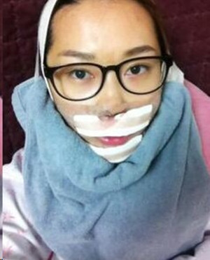 地包天手術(shù)前后過程以及對比照，真實(shí)案例分享