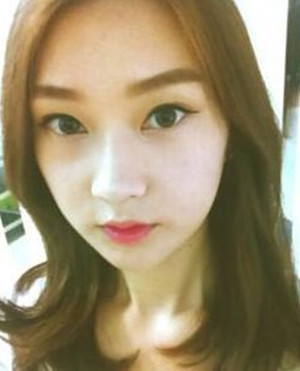 地包天手術(shù)前后過程以及對比照，真實(shí)案例分享