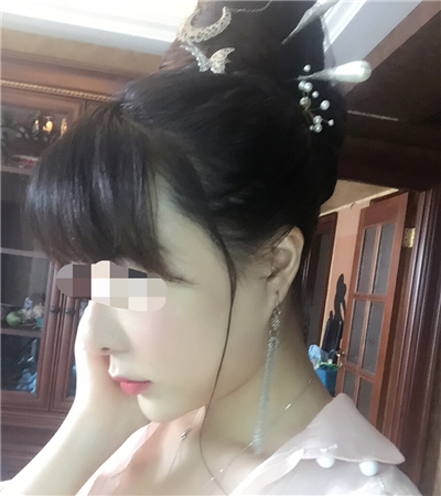 北京延世金慧燕做的果酸嫩膚，分享手術(shù)過程和前后對比果照片~