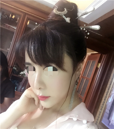 北京延世金慧燕做的果酸嫩膚，分享手術(shù)過程和前后對比果照片~