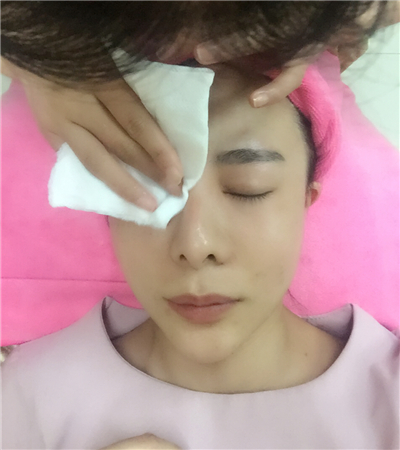 北京延世金慧燕做的果酸嫩膚，分享手術(shù)過程和前后對比果照片~