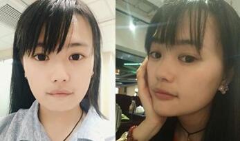 下巴整形前后對(duì)比圖