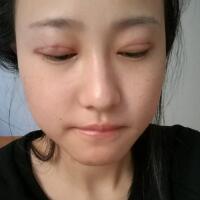 割雙眼皮恢復過程分享，整形價格3800元
