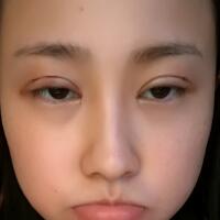 割雙眼皮恢復過程分享，整形價格3800元