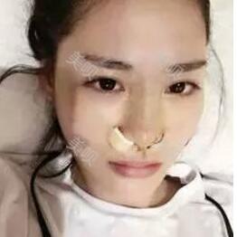 杭州廣仁做的硅膠假體隆鼻+鼻翼縮小我很滿意