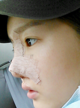 隆鼻術失敗修復整形術后果分享