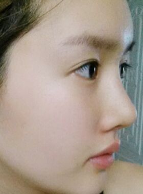 隆鼻術失敗修復整形術后果分享