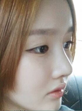 隆鼻術失敗修復整形術后果分享