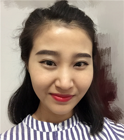 玻尿酸注射隆鼻前后對(duì)比果圖片分享，大同美神賈文醫(yī)生做的~