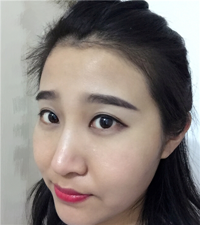 玻尿酸注射隆鼻前后對(duì)比果圖片分享，大同美神賈文醫(yī)生做的~