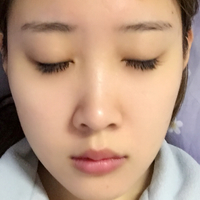膨體隆鼻+墊鼻尖一個(gè)月時(shí)間的恢復(fù)過(guò)程